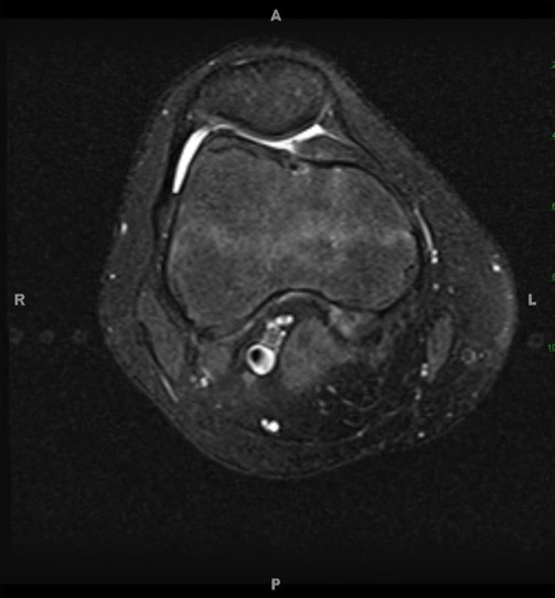 Figure 2 for case Mild alta and early mucoid ACL